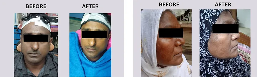 Natural Skin Rejuvenation Results Natural Skin Rejuvenation Results