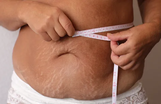 Stretch Marks Reduction