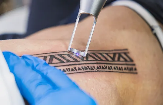 Tattoo Removal (Q-Switch Laser)