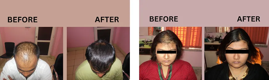 Visible Hair Restoration Outcomes Visible Hair Restoration Outcomes