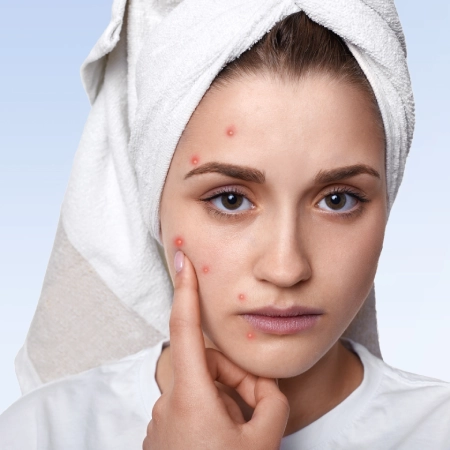 Anti Acne Therapy