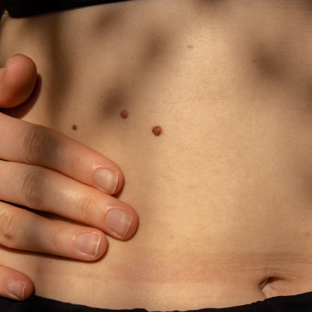 Birth Mark Removal