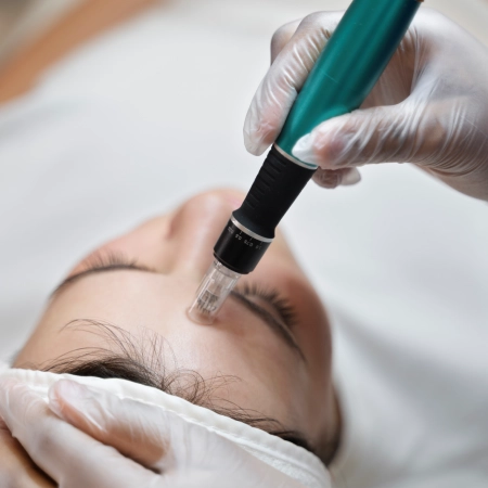 Microneedling RF