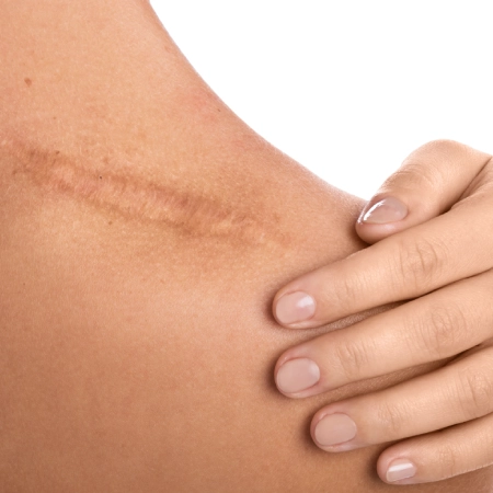 Scar Mark Removal