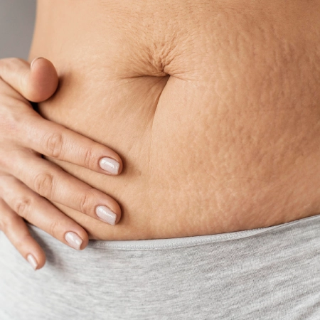 Stretch Marks Removal
