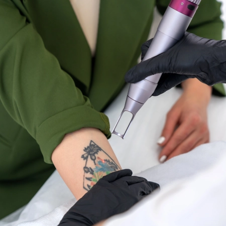 Tattoo Removal