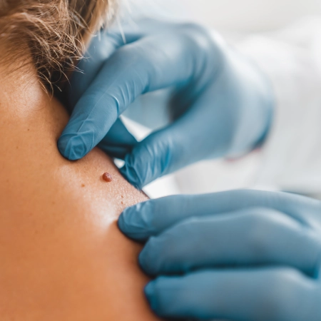 Wart Removal